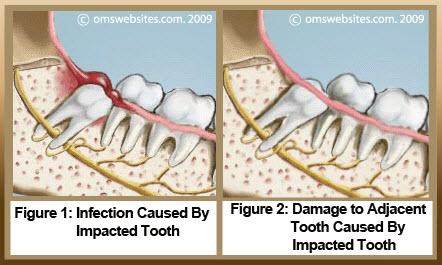 healing process extracted wisdom teeth