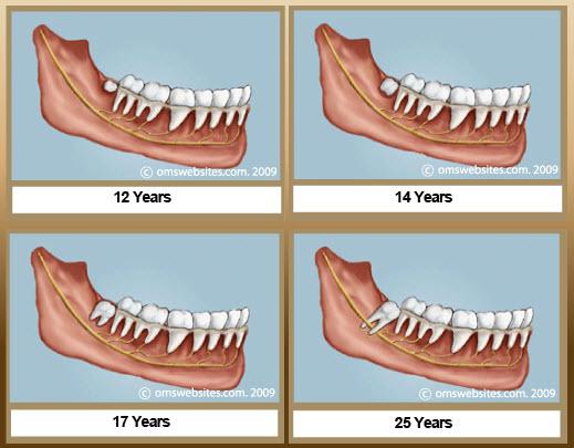 at what age wisdom teeth appear